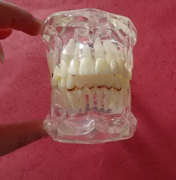 Dental Teeth Pathology Model With Half Implant visar tydligt den ursprungliga formen och hela strukturen5674354