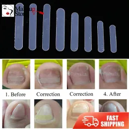 도구 100pcs/box ingrown pedicure 발톱 교정 클립 발가락 네일 스티커지지 발톱 두꺼운 필름 패치 풋 케어 도구