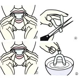 Tirantes de ortodonia de Silicona, Bandejas de Moldeo para Blanqueamiento Dental, Corrector deientes termoformado Movable Personizado, 2/4 piezas