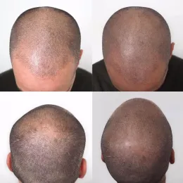 Molduras PM Marca Hair Scalp Micropigmentation Pigmment Powder derrubam tinta de maquiagem permanente