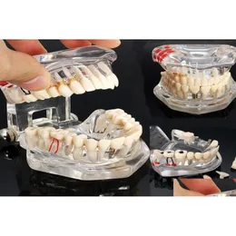 Konst och hantverk Dental Implant Disease Teeth Model With Restoration Bridge Tooth Dentist for Science Teaching Study13594528 Drop Del DH9NR