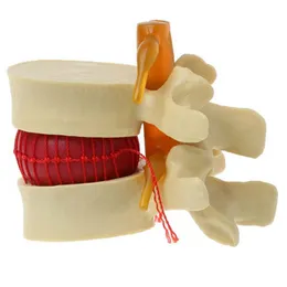 Suprimentos de arquivamento Modelo de vértebra lombar anatômica da coluna Hérnia de disco Anatomia Ferramenta de ensino 230803