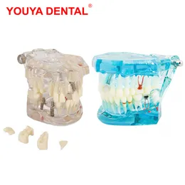 Other Oral Hygiene Dental Implant Model Dentistry Dentist Disease Tooth Implant Model Teeth With Restoration Bridge For Medical Science Teaching 230815