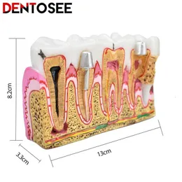 Altro modello di anatomia della carie dentale dell'igiene orale Modello di denti denti denti per denti per insegnamento orale Modello 230815