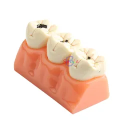 기타 구강 위생 1pcs 치과 교육 모델 환자 해부 충치 치아 모델 경구 치아 모델은 제거 할 수 있습니다. 치과 실험실 모델 230815