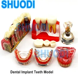 Andere Mundhygiene 1 Stück Zahnimplantat-Demonstrationsmodell Zahnstudie Lehrmodell Kommunikation Zahnärztliche Deckprothese Innen-Unterkiefermodell 230524