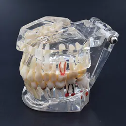 Altri accessori dentali per l'igiene orale Modello di denti di alta qualità Studio sull'insegnamento delle malattie degli impianti dentali 230720