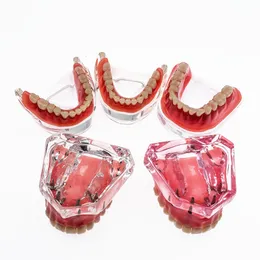 Andra orala hygienöverdrivna implantat tänder modeller tandprotesständer med tandkliniceringsmodell 230228