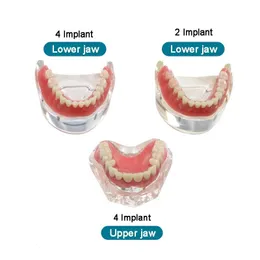 Other Oral Hygiene Dental Implant Restoration Teeth Model Overdenture Superior Demo Model Demonstration Teeth Model 230607