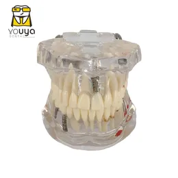 Other Oral Hygiene Transparent Disease Teeth Model Dental Implant Teeth Model Dentist Dental Student Learning Teaching Research Communication 230609