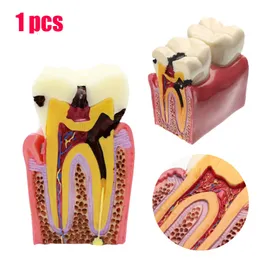 기타 구강 위생 1pcs 치과 치아 모델 6 회 충치 연구 의치 치아 모델 치과 의사 연구 및 연구 치과 연구 230617