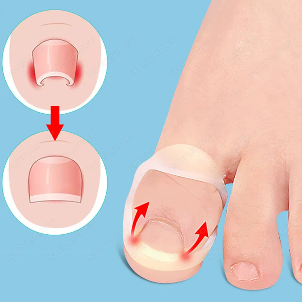 Toenail straightener discount