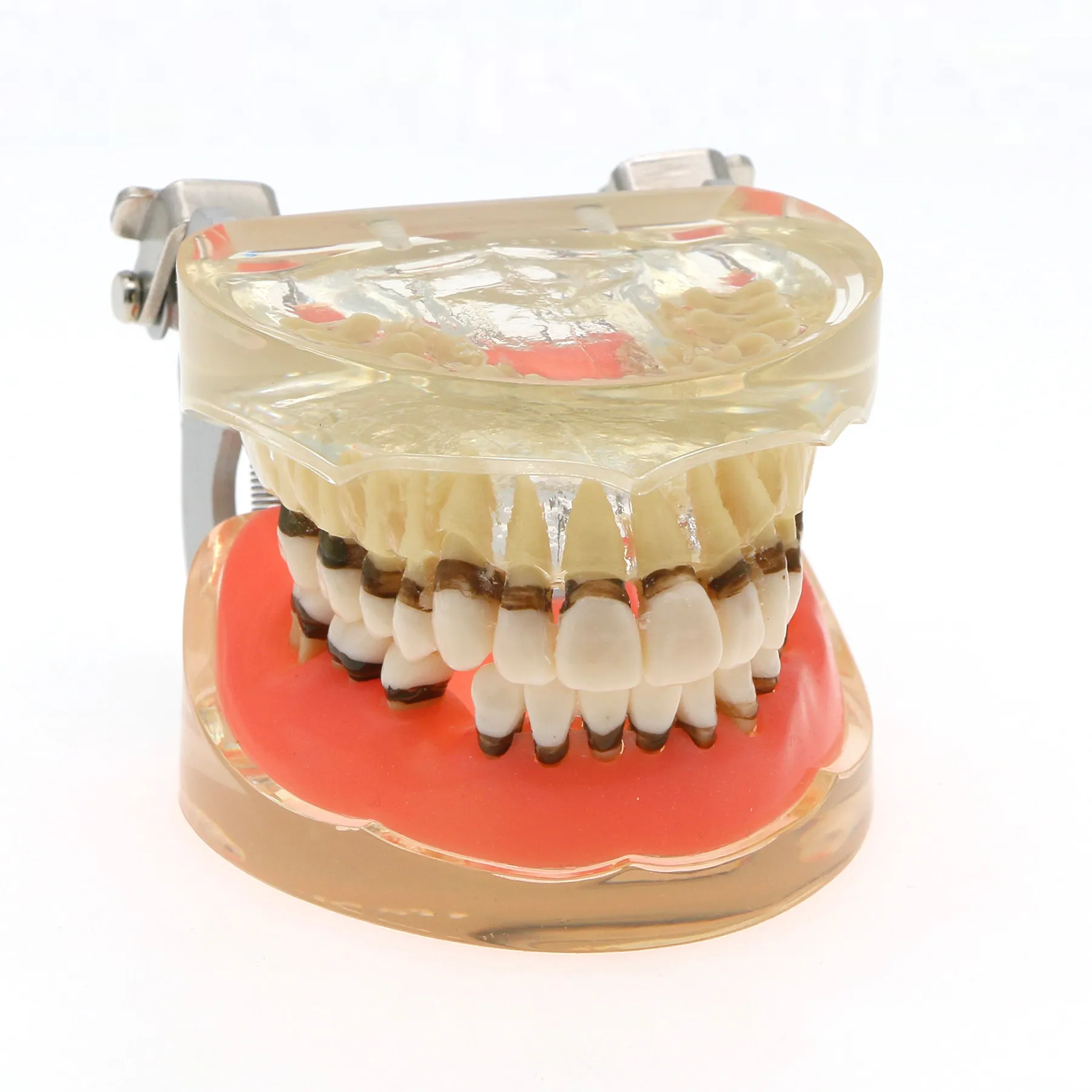 Adult Pathological Transparent Periodontal Disease Study Teeth Model – Dental Education Tool