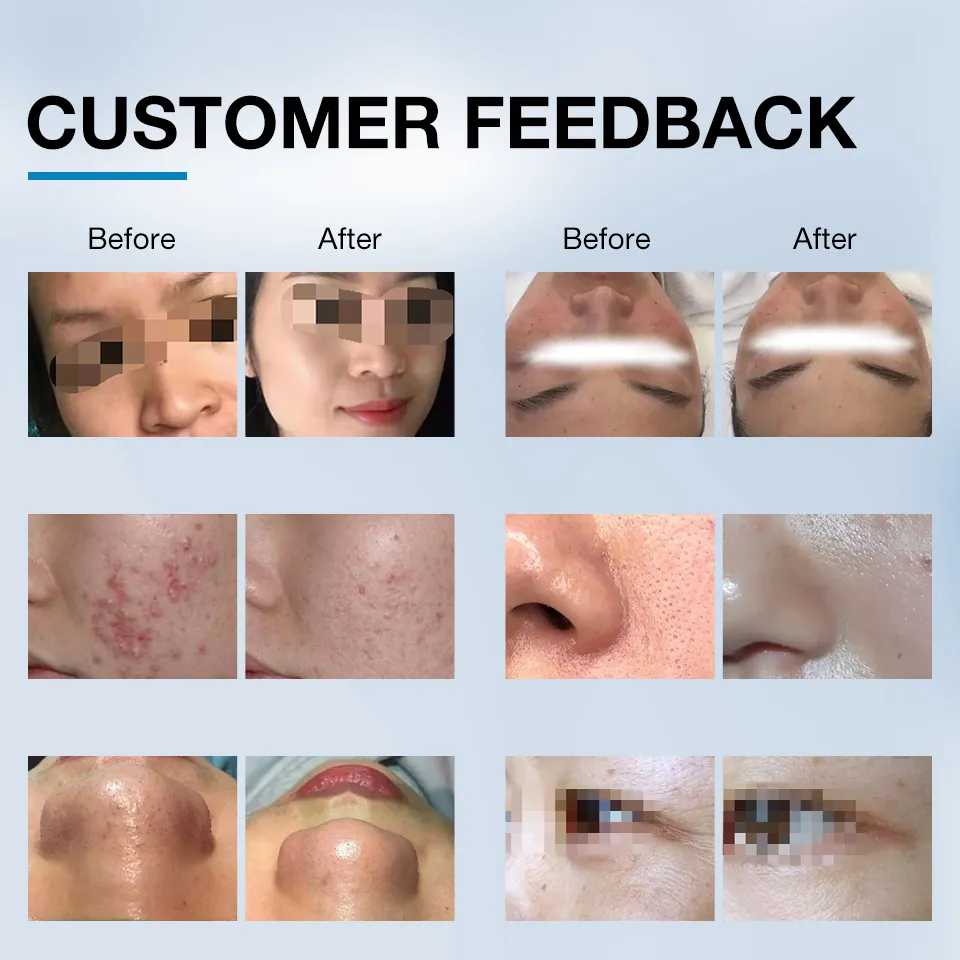 15 In 1 Hydra Dermabrasion RF LED Light SPA Water Dermabrasion Machine